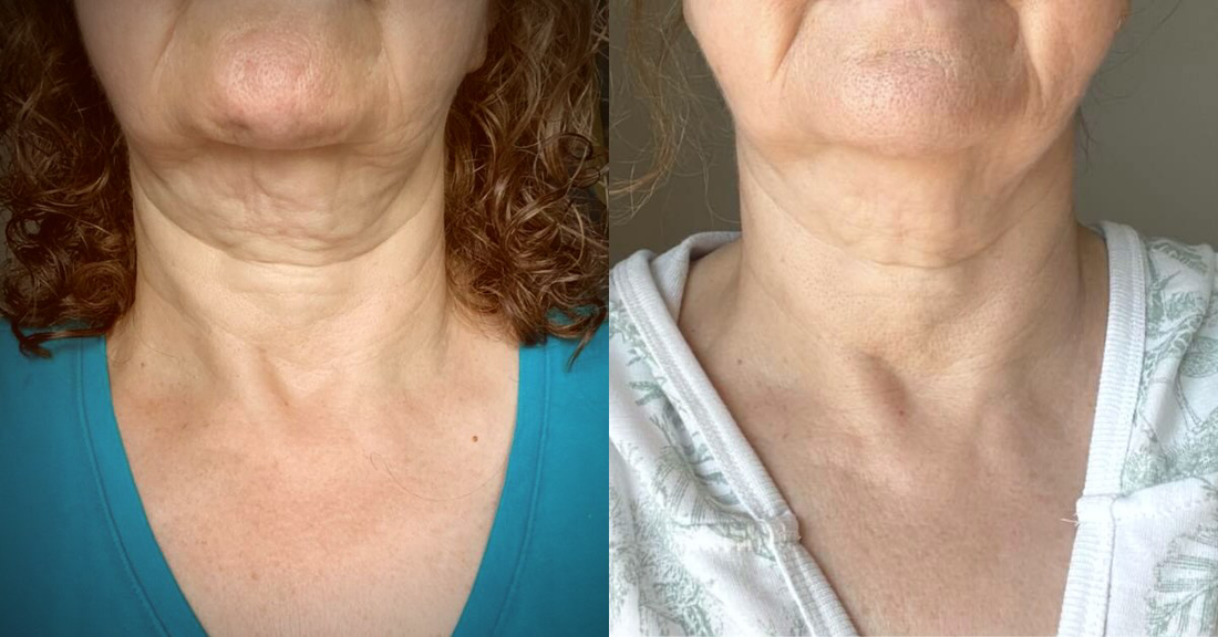 One Woman Decided to Take Before and Afters with her Fièra Neck Cream