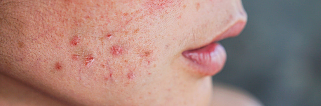 What Causes Age Spots and Sun Spots After 40 and How to Fade Them